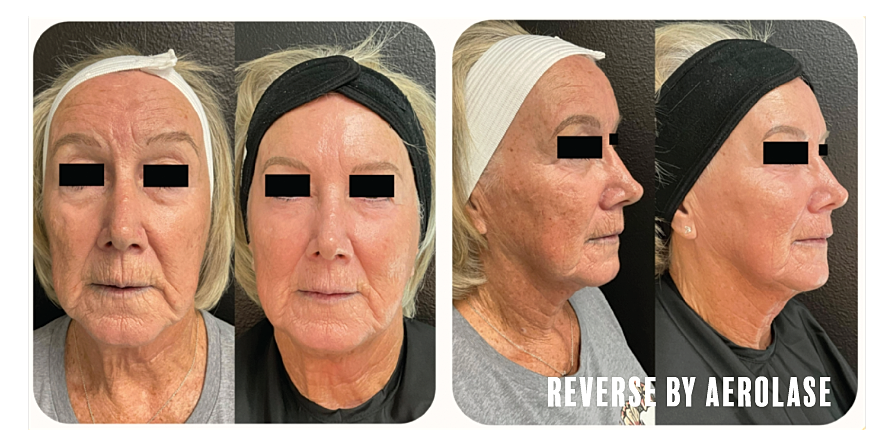 Before and after facial treatment results